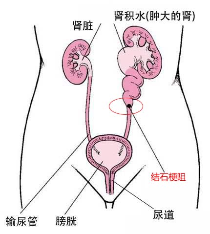 男子体内取出6公分大膀胱结石  震惊所有人(图3)