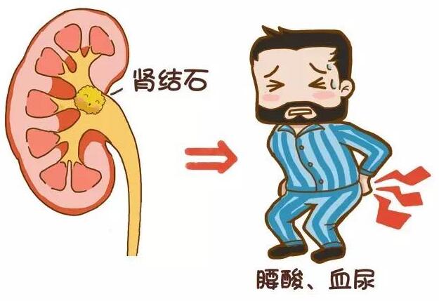 腰部酸痛、血尿——这是肾结石惹的祸(图1)