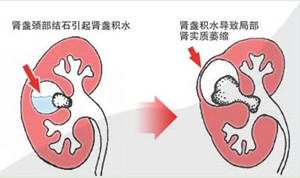 专家在线解答：肾积水的症状有哪些呢(图1)