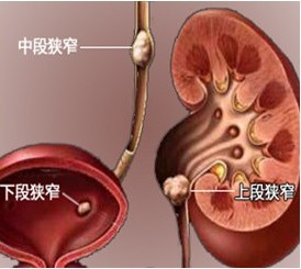 专家解析：什么是输尿管结石(图1)