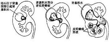 四川结石病医院