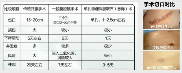 了解胆结石症状，避免扩大危害！(图4)