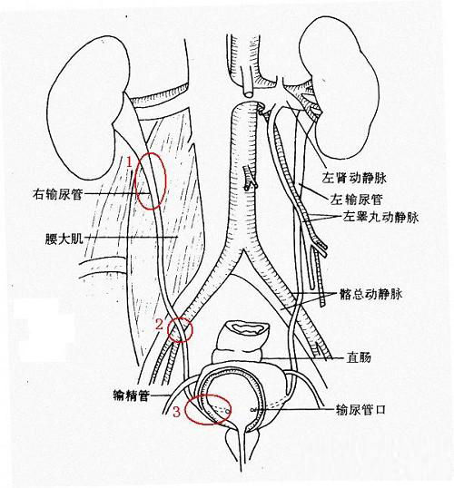 类别:输尿管结石