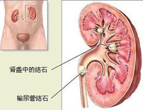 解析左肾结石(图1)