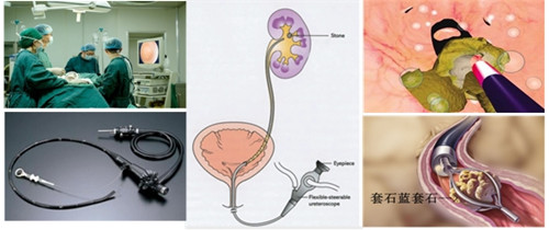 肾结石治疗方法(图2)