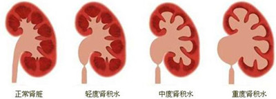 肾结石的临床表现有哪些(图2)