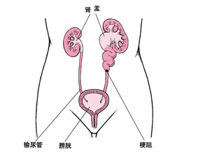 肾结石不治疗会怎样(图2)