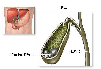 胆结石疗法多，选择好的对的是关键！(图1)