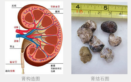 肾结石需要怎么防治?(图1)
