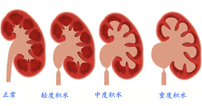 痛得要死的输尿管结石，终于解决了(图2)