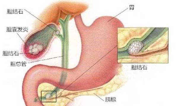 胆结石吃东西就能排出来？还要医院干啥？(图1)