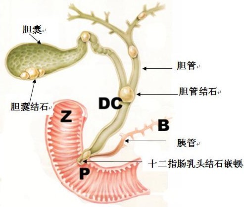 药物排胆结石的可行性分析(图2)