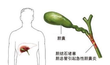 多大的胆结石需要治疗？一定要切胆吗？(图2)