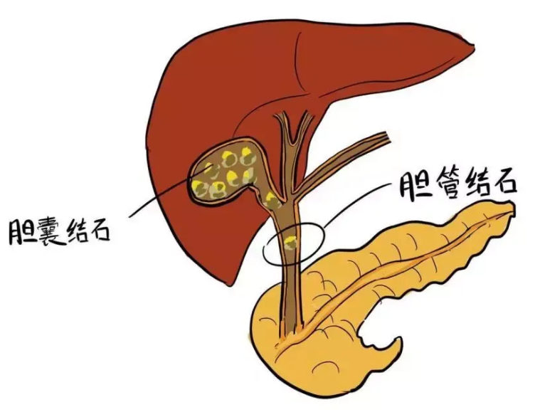 四川胆结石专科医院科普：胆结石什么阶段治疗最好？(图3)