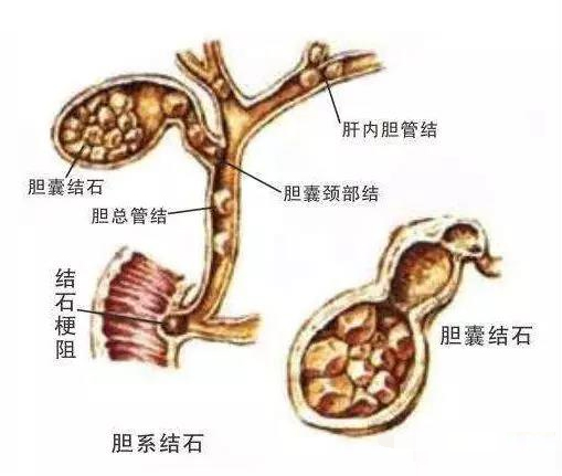 四川胆结石专科医院科普：胆结石什么阶段治疗最好？(图2)